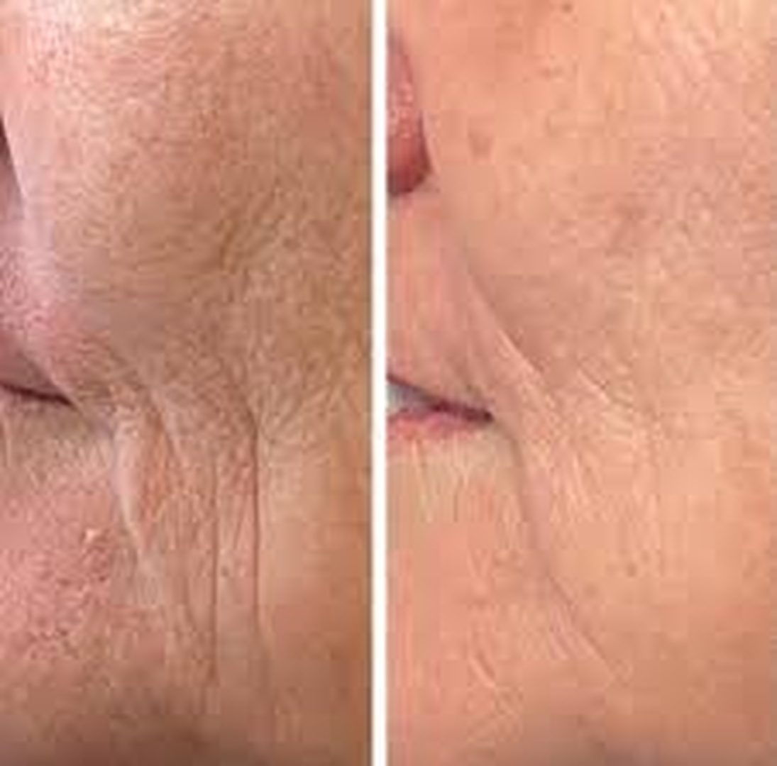 Anti-Ageing Therapies in Boca Raton: A Step-by-Step Guide to Looking and Feeling Your Best 1 Close-up split image of the outer eye and cheek showing deeper wrinkles on the left and smoother skin on the right.